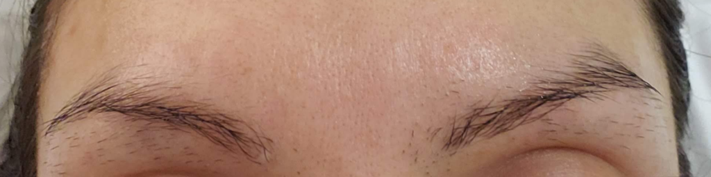 Unsightly eyebrow hair regrowth phase after overplucking eyebrows